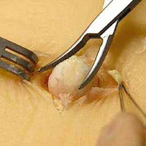 Sebaceous Cyst Pad - Double