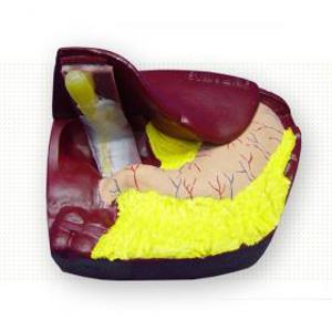 Cholecystectomy Model 9001