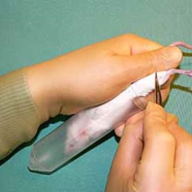The leg is shaved in the direction of hair growth with a number 11 scalpel blade until the vein is visible.
