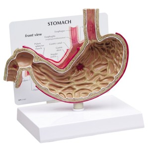 Stomach With Ulcers – Model By GPI Anatomicals