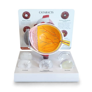 Cataract Eye – Model By GPI Anatomicals Cataract Eye – Model By GPI Anatomicals