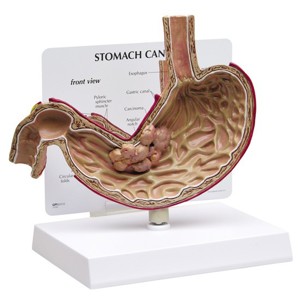 Stomach Cancer – Model